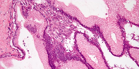 Tiroide neoplasie