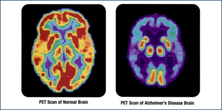 pet diagnosi alzheimer