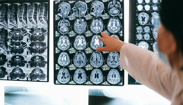 invecchiamento del cervello