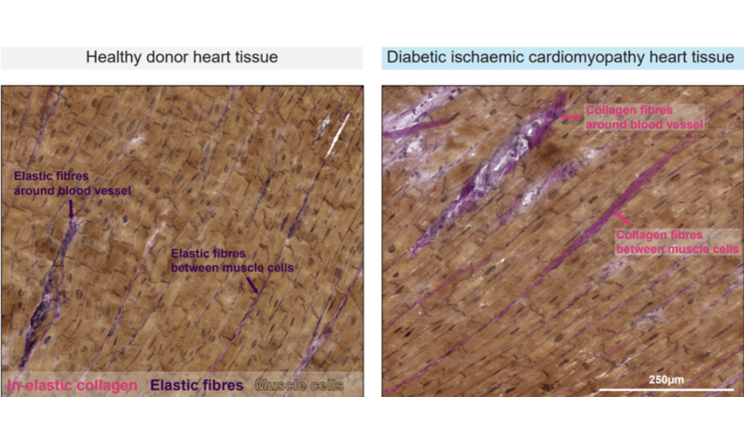 effetto metabolico del diabete sul cuore