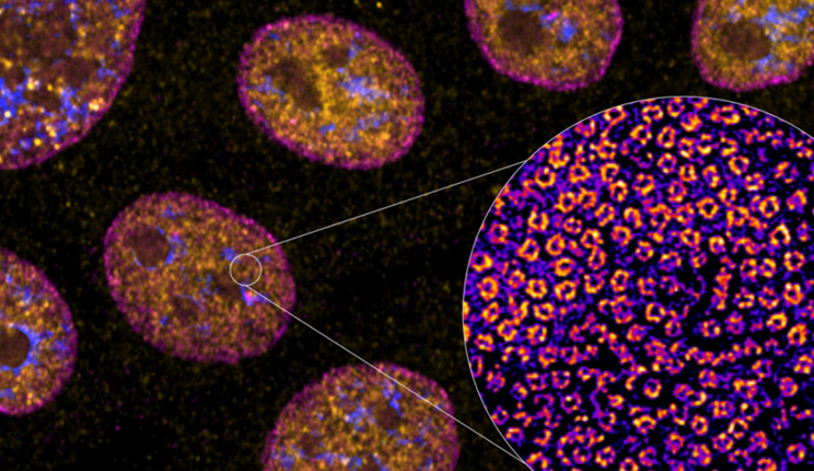Una nuova molecola a RNA per migliorare le terapie contro il tumore al pancreas