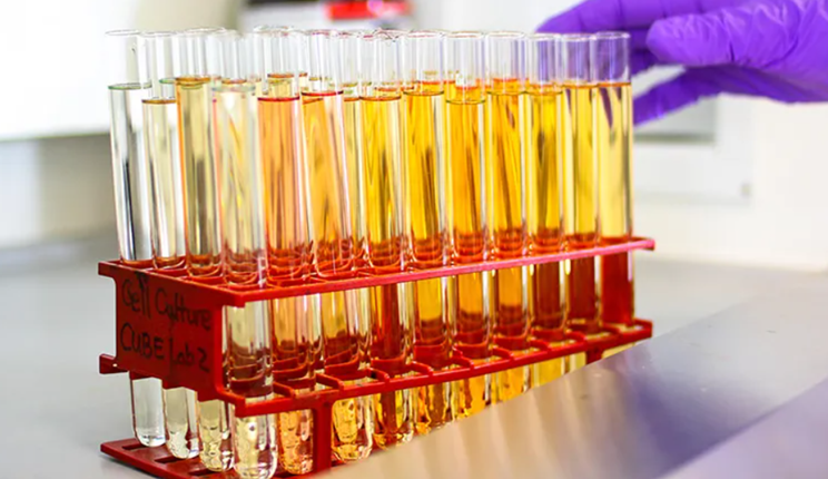 Un test delle urine potrebbe aiutare a individuare il cancro ai polmoni anni prima della comparsa dei sintomi