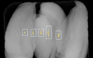 Advanced Bone Detection with X-ray Inspection